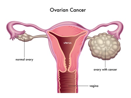 Laparoscopic Oophorectomy for Ovarian Torsion • Video •