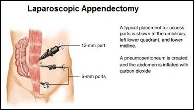 appendix-removal-surgery