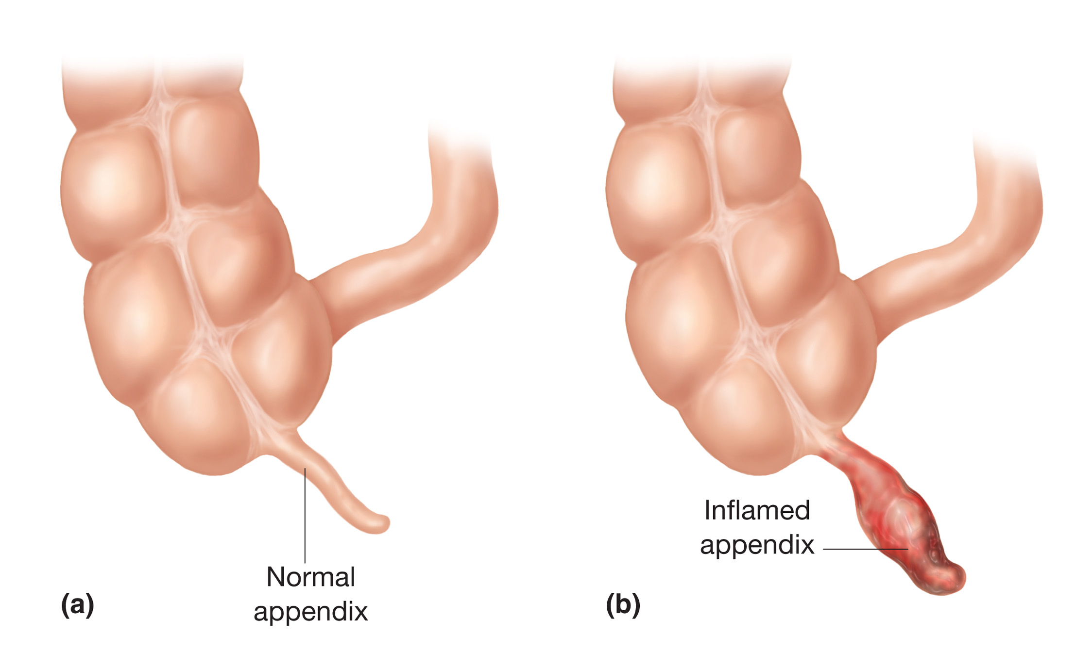 appendix-surgery-mumbai