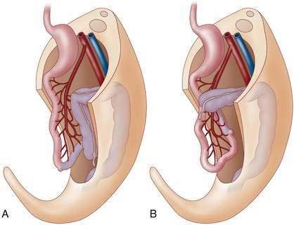 intestine-malrotation-surgery