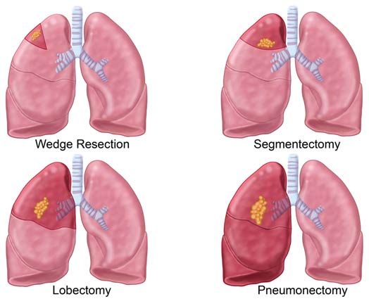 lung-cancer-treatments
