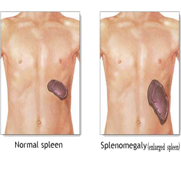 spleen-treatments
